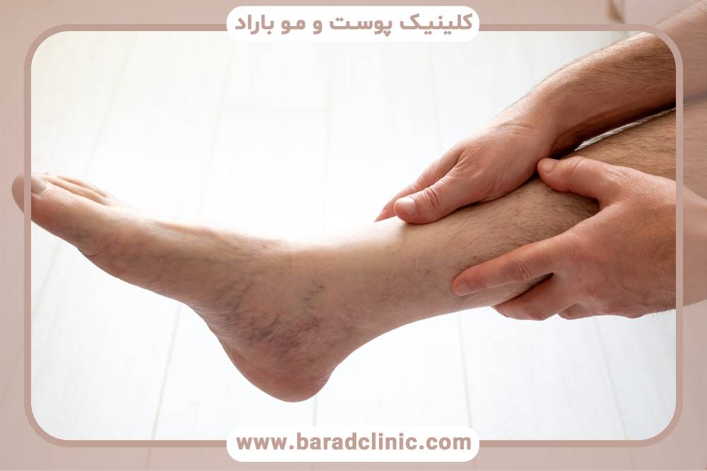 درمانی اثبات شده برای وریدهای واریسی و وریدهای عنکبوتی