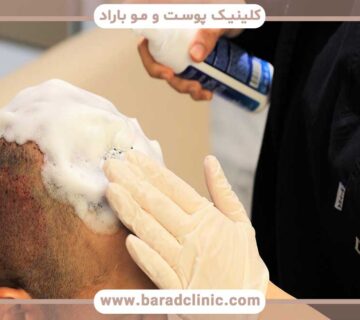 Care after hair transplant