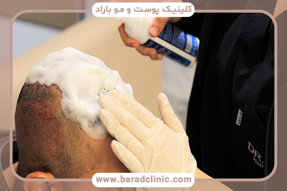 Care after hair transplant