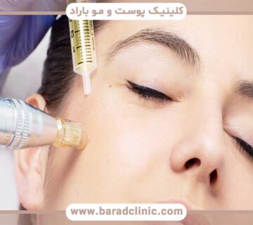 Care after mesogel injection
