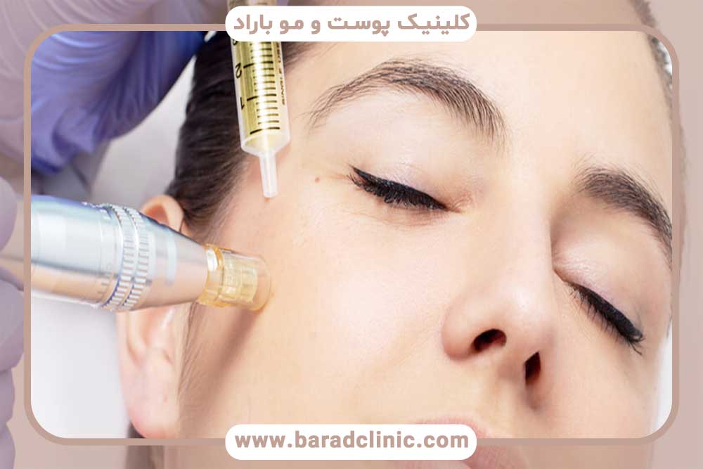 Care after mesogel injection