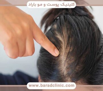 Can thalassemia patients do hair transplant?