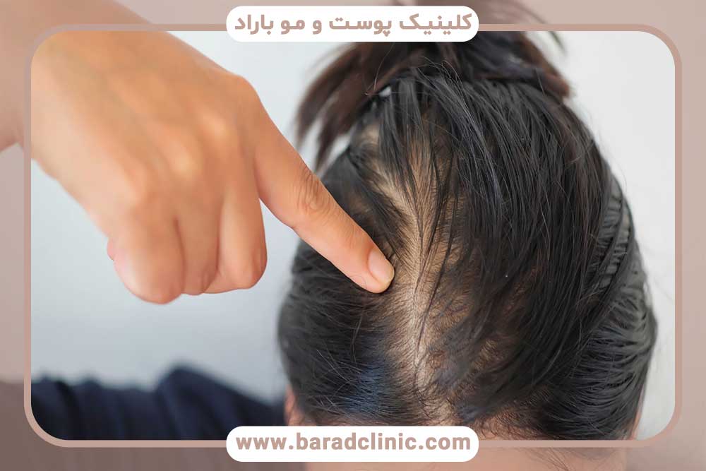 Can thalassemia patients do hair transplant?