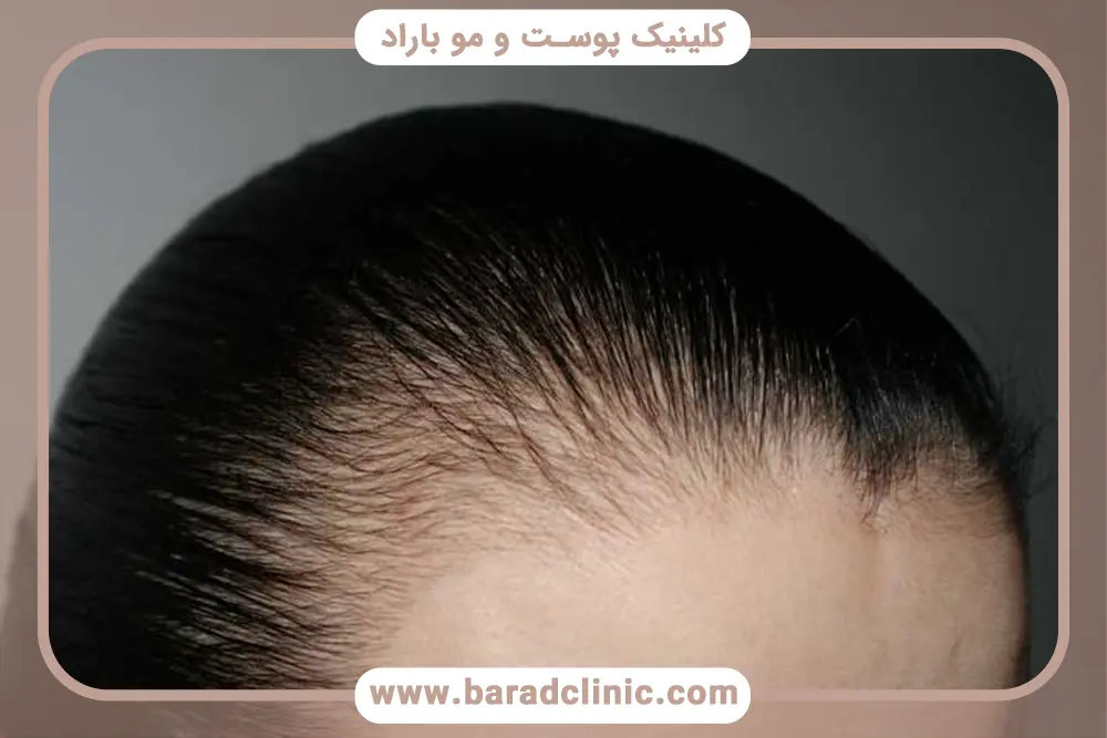 راهکارهای درمانی برای خالی بودن کف سر در زنان و مردان
