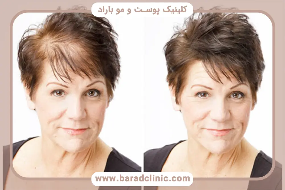 افزایش سن و خالی شدن کف سر و جلو سر در بانوان