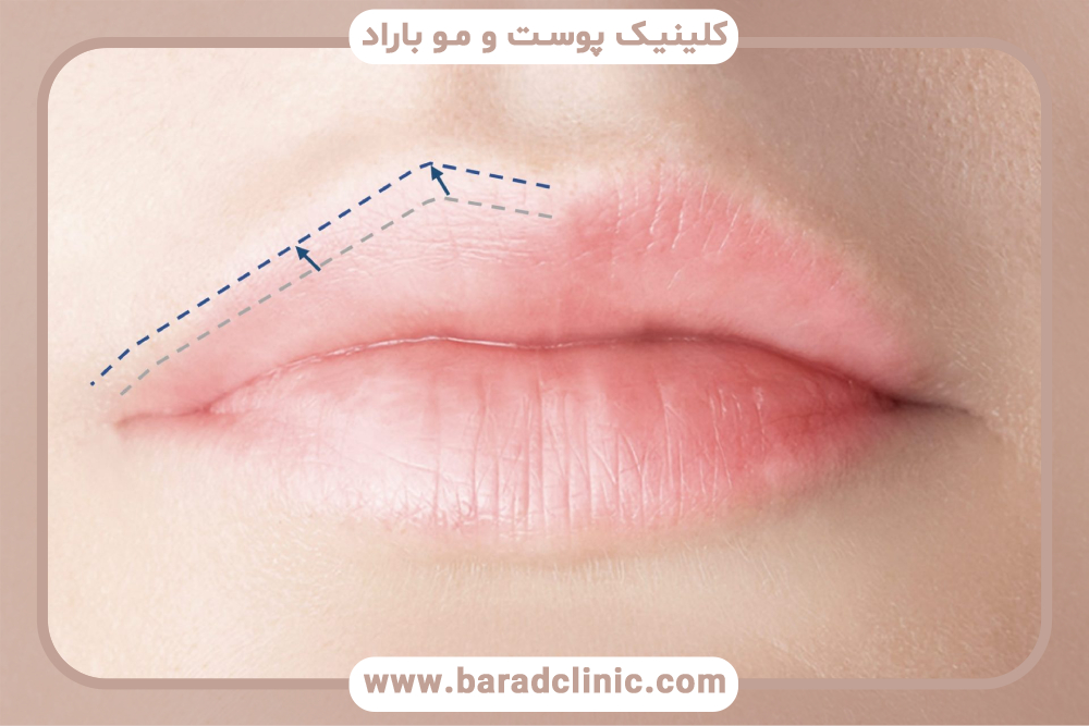 عدم تقارن لب