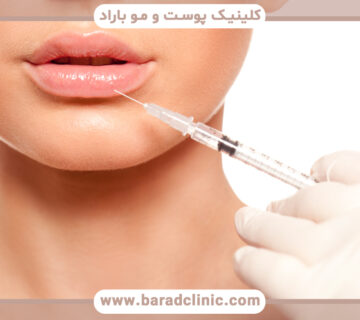 تورم بعد از تزریق ژل چقدر طول میکشد؟