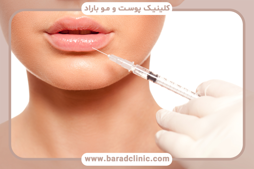 تورم بعد از تزریق ژل چقدر طول می‌کشد؟