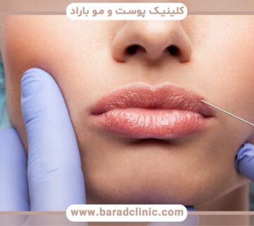 تزریق ژل لب نچرال