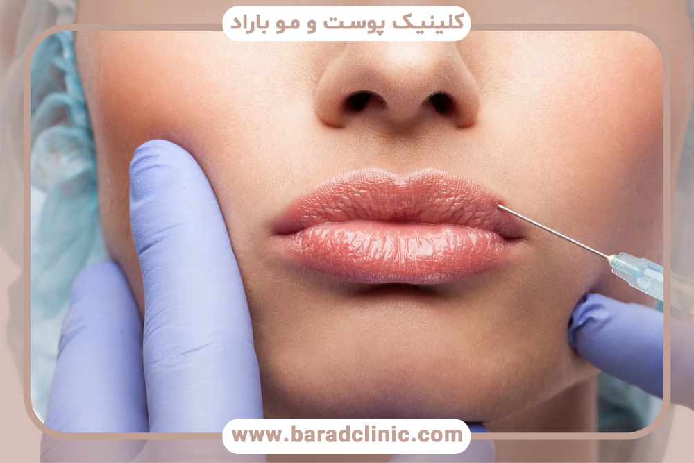 تزریق ژل لب نچرال