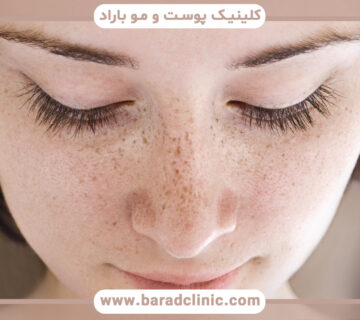 راههای مختلف درمان کک و مک چیست؟ راههای مختلف درمان کک و مک چیست؟