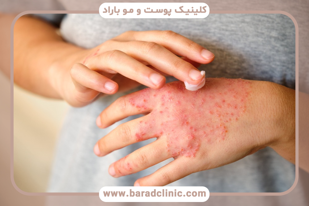 انواع اگزمای پوست و راهکارهای درمان اگزما چیست؟