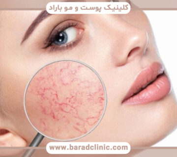 اسکلروتراپی صورت چیست و چه کاربردی دارد؟