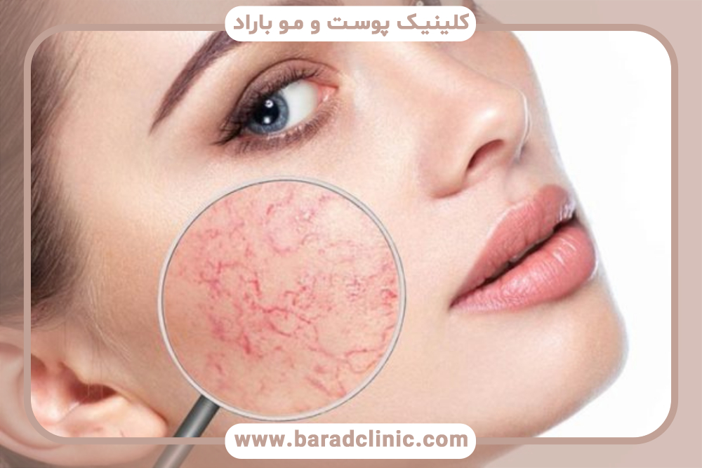 اسکلروتراپی صورت چیست و چه کاربردی دارد؟