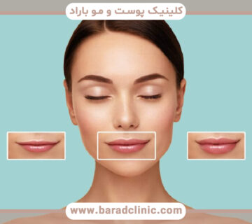 تغییر فرم صورت با فیلر