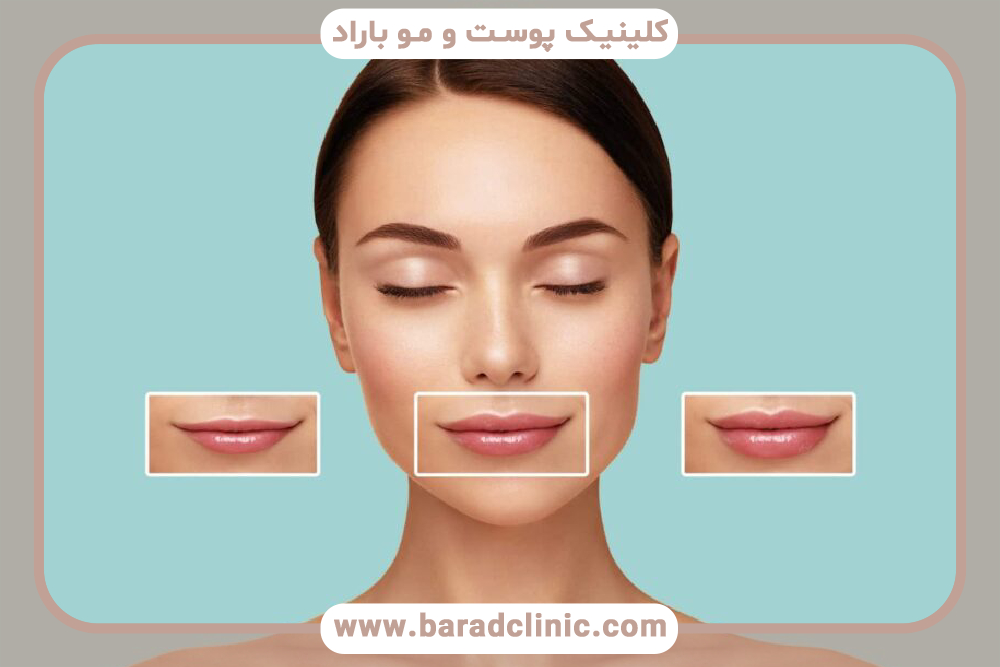 تغییر فرم صورت با فیلر