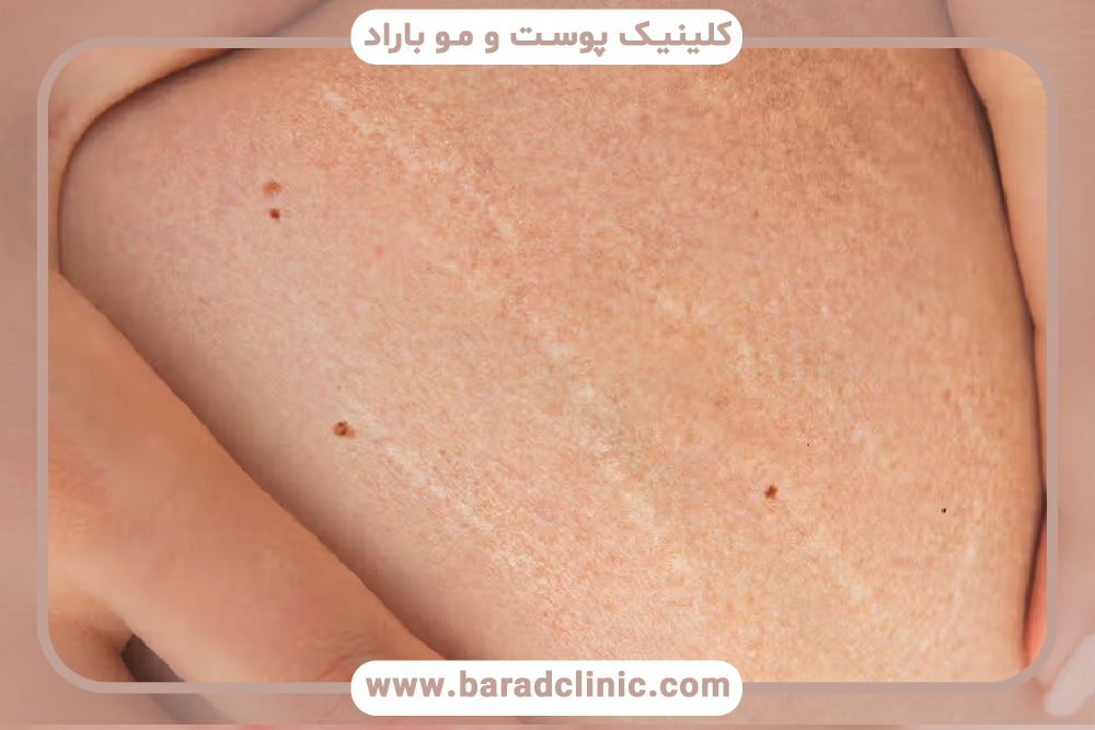 لیفت بدن در بیماران دارای اسکار قدیمی