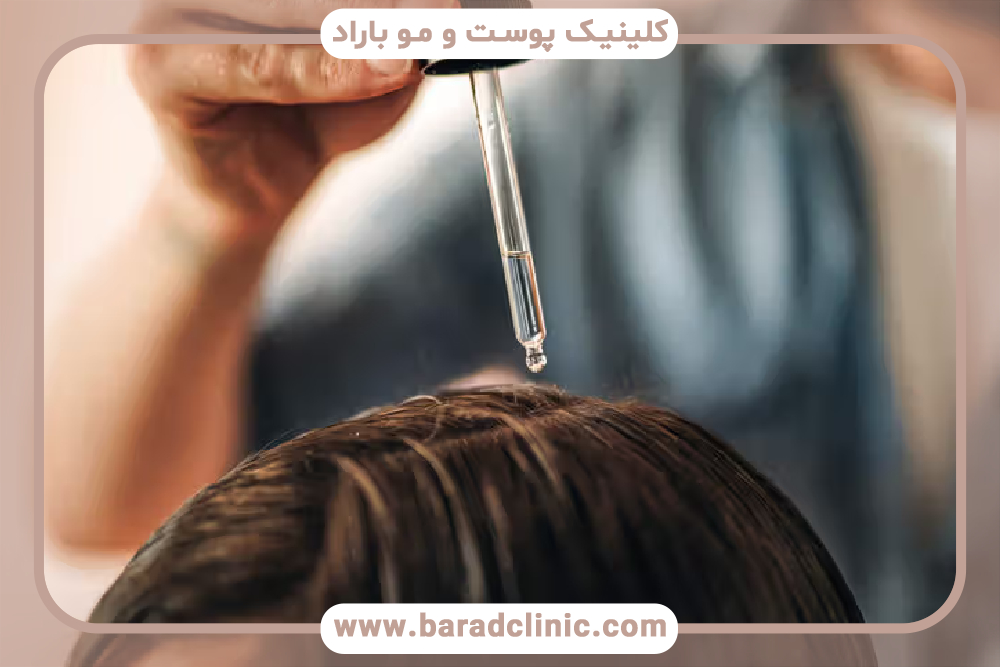 درمان شوره سر