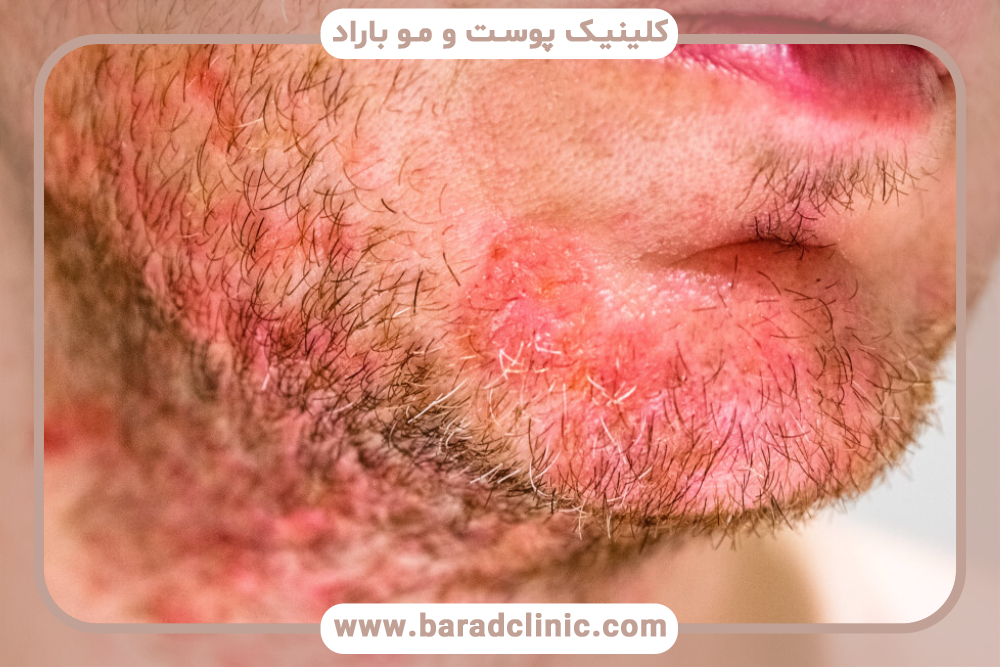 التهاب فولیکول مو یا فولیکولیت چیست؟