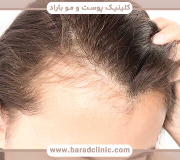 Loss of hair on the front of the head