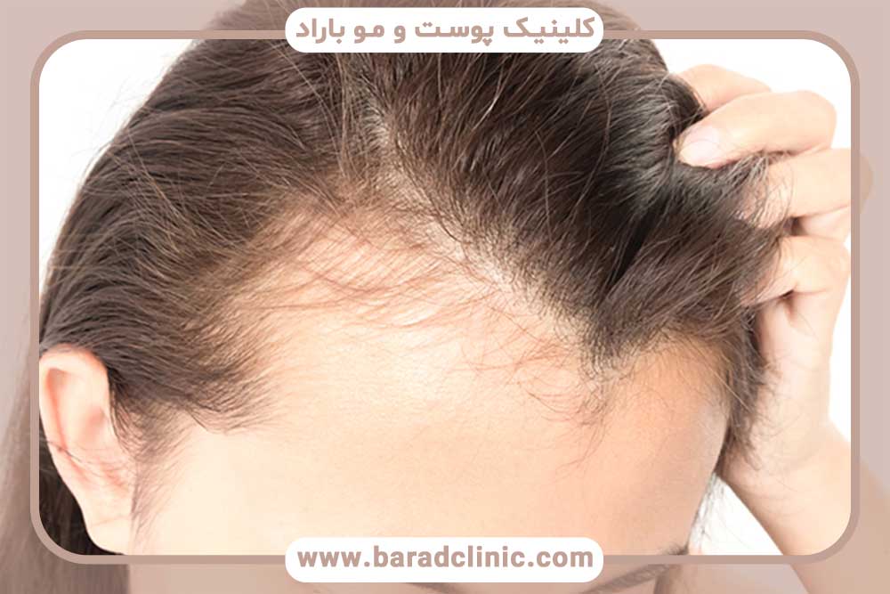 Loss of hair on the front of the head