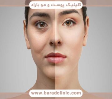 Lower eyelid blepharoplasty