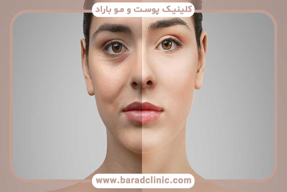 Lower eyelid blepharoplasty