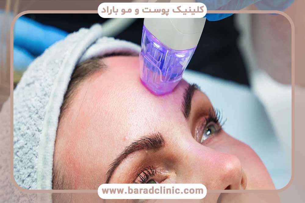 Microneedling with radio frequency