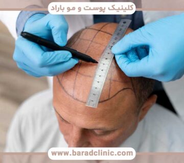 Necessary measures before hair transplantation
