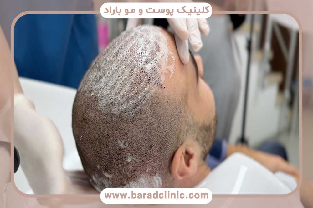 Shampoo suitable for implants