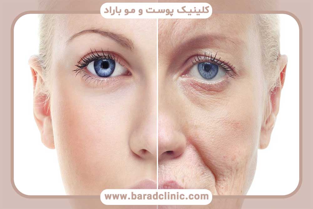 Premature aging of the skin