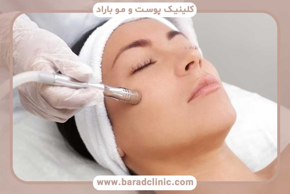 microdermabrasion