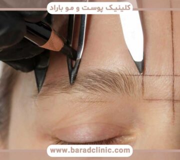 Eyebrow transplant with long hair