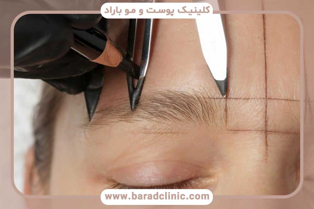 Eyebrow transplant with long hair