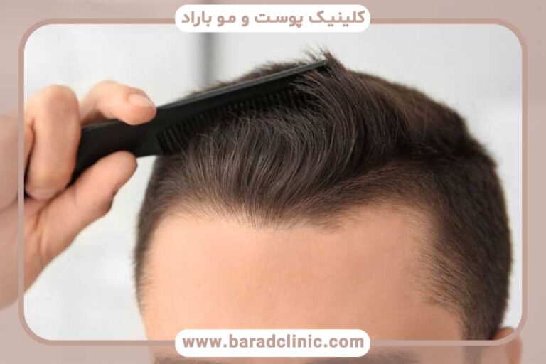 Natural hair transplantation