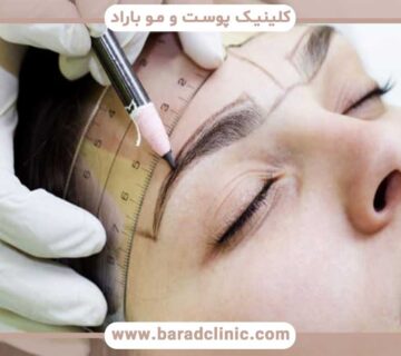Eyebrow implantation without surgery