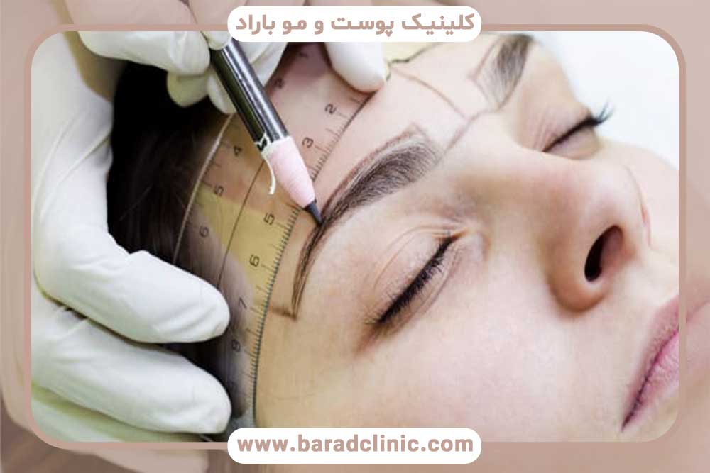 Eyebrow implantation without surgery