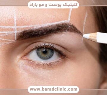 Flap in eyebrow transplantation