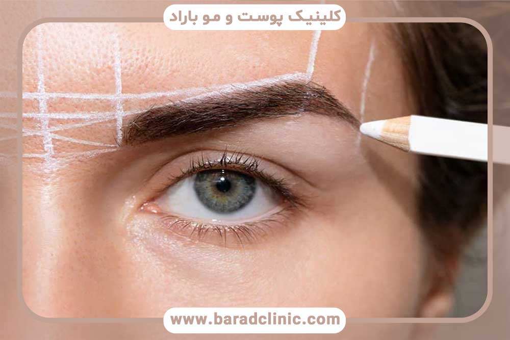 Flap in eyebrow transplantation