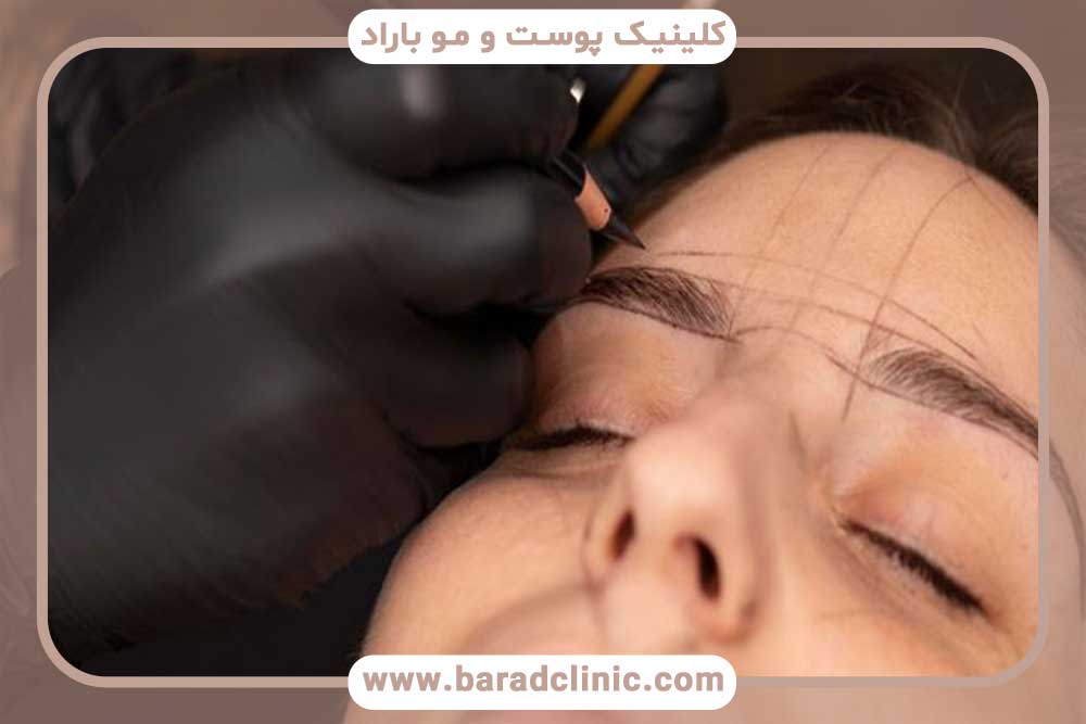 Eyebrow transplantation methods