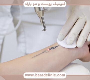راههای پاک کردن تاتو با لیزر