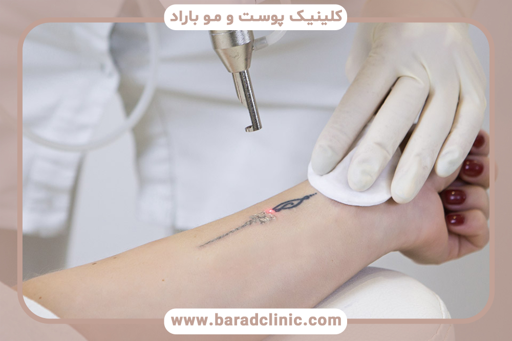 راه‌های پاک کردن تاتو با لیزر