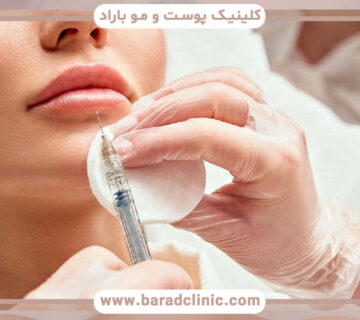 گرانولومهای بعد از تزریق ژل لب