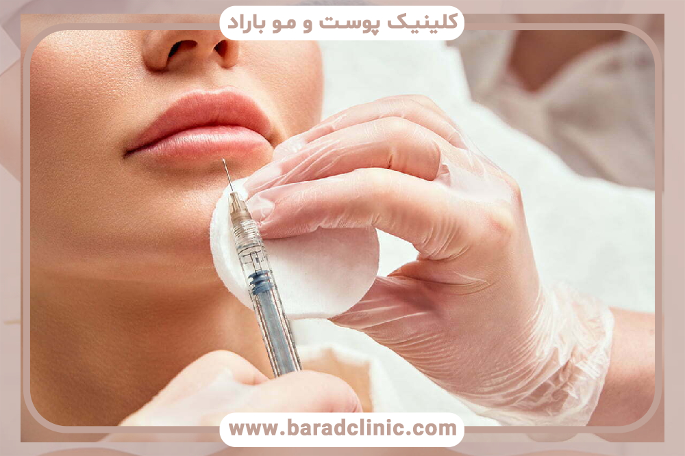 گرانولوم‌های بعد از تزریق ژل لب