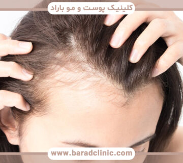 محلول ماینوکسیدیل چیست و چه کاربردی دارد؟