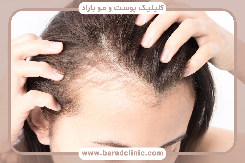 محلول ماینوکسیدیل چیست و چه کاربردی دارد؟