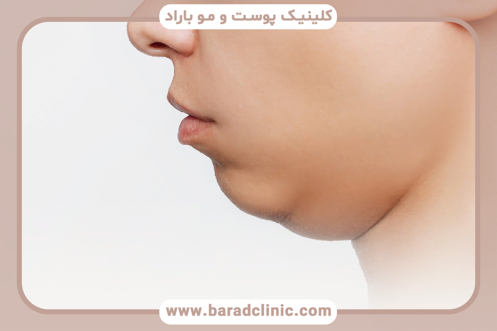 راه‌های غیرجراحی لیفت گردن برای افتادگی پوست