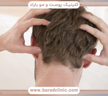 خشکی پوست سر