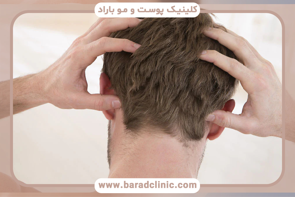 خشکی پوست سر