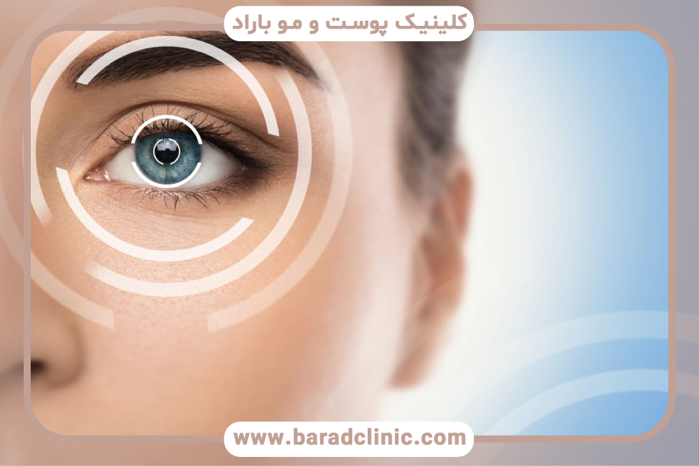 کاربرد لیزر برای دور چشم چیست؟